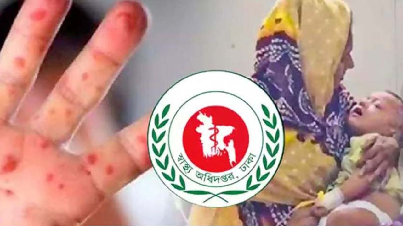 হাম উপসর্গ নিয়ে আরও ৩ শিশুর মৃত্যু