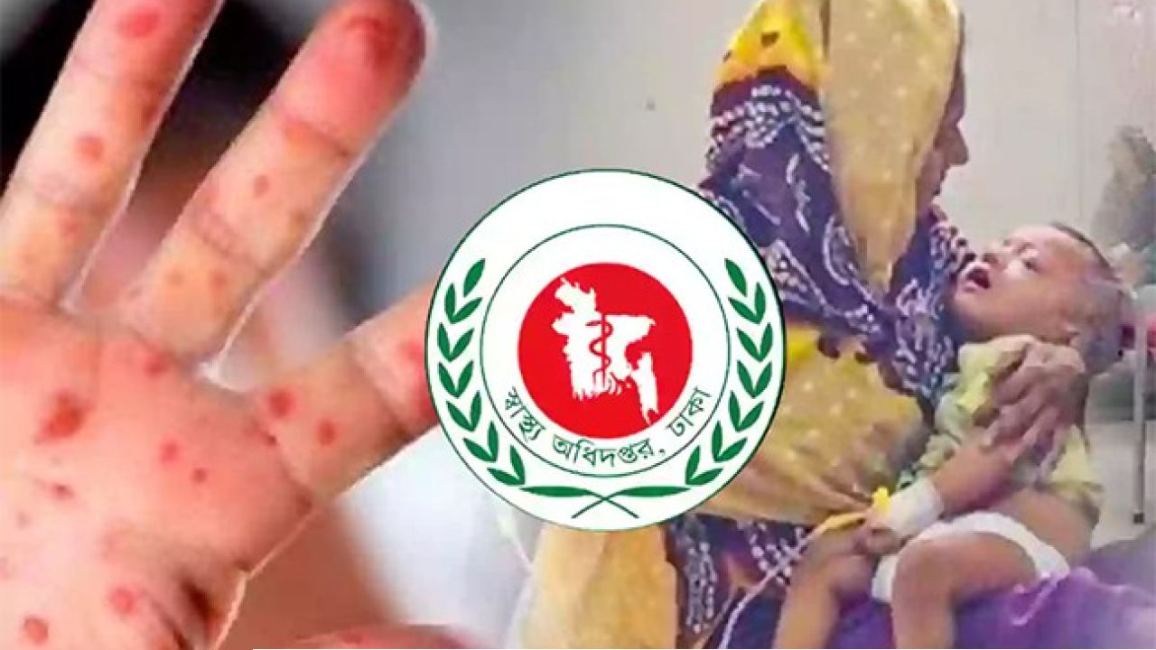 দেশে বাড়ছে হাম: ২৪ ঘণ্টায় ৪ শিশুর মৃত্যু