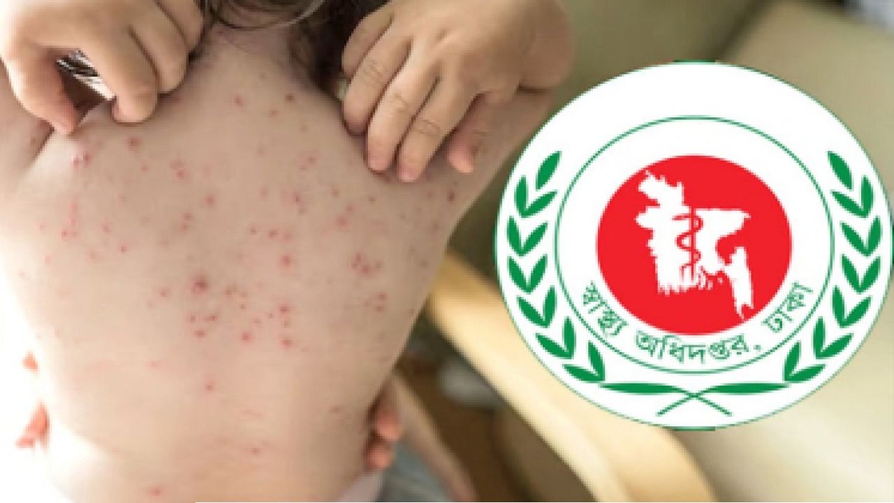 একদিনে হাম উপসর্গে প্রাণ গেল আরও ৩ শিশুর