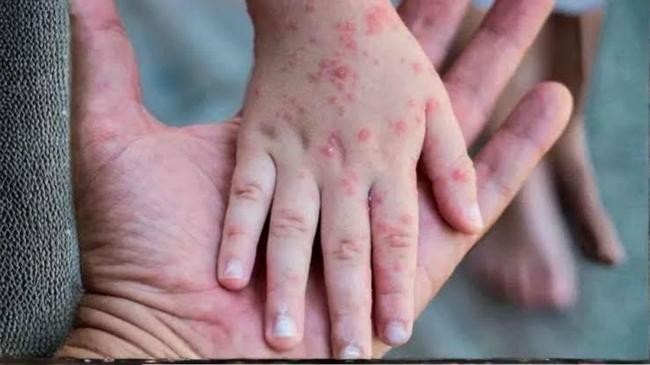 স্বস্তি নেই হামে, দেশে মৃত্যু ৭৪৭ ছাড়াল