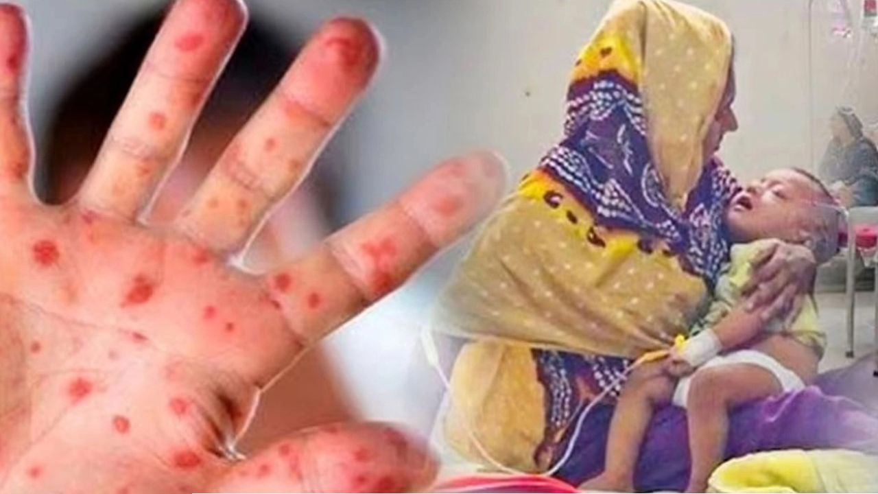 হামের উপসর্গে আরও ৮ শিশুর মৃত্যু