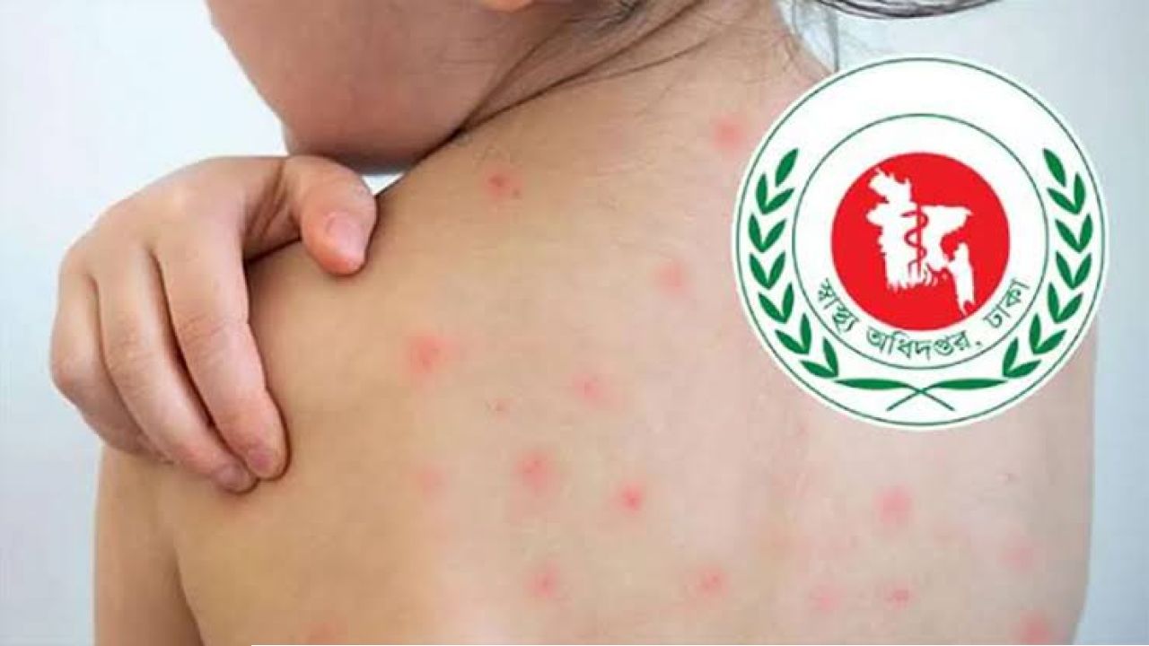 হামের দাপট কমছেই না, একদিনে আরও ৭ প্রাণহানি